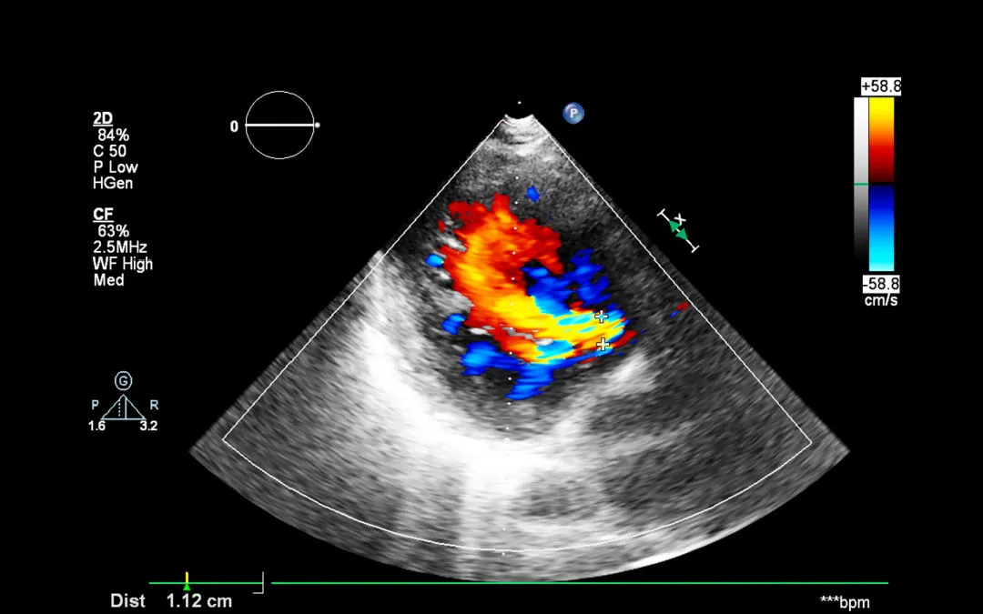 What is an Echo with a Color Doppler Test?
