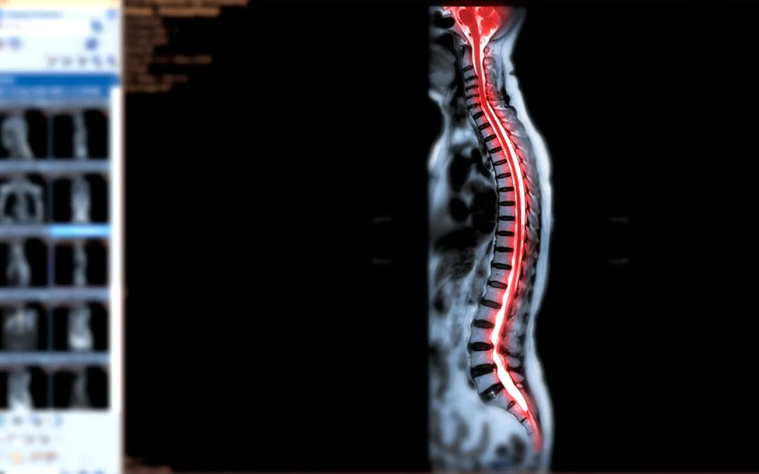 MRI Whole Spine Screening: A Comprehensive Diagnostic Approach