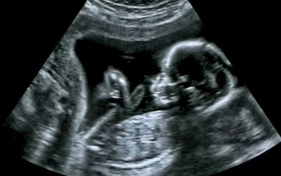 Fetal abnormalities: Know the role of level 2 ultrasound in its early detection