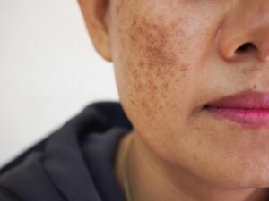 Skin types, problems and solutions mfine - Melasma