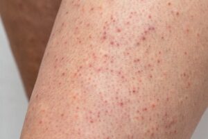 Skin types, problems and solutions mfine - Keratosis Pilaris 