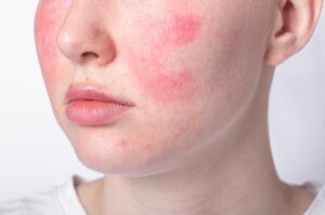 Skin types, problems and solutions mfine - Sensitive skin