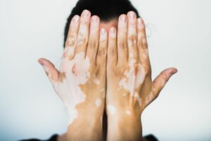 Skin types, problems and solutions mfine - Vitiligo