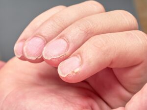 Skin types, problems and solutions mfine - Nail problems