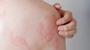 Skin types, problems and solutions mfine - Hives