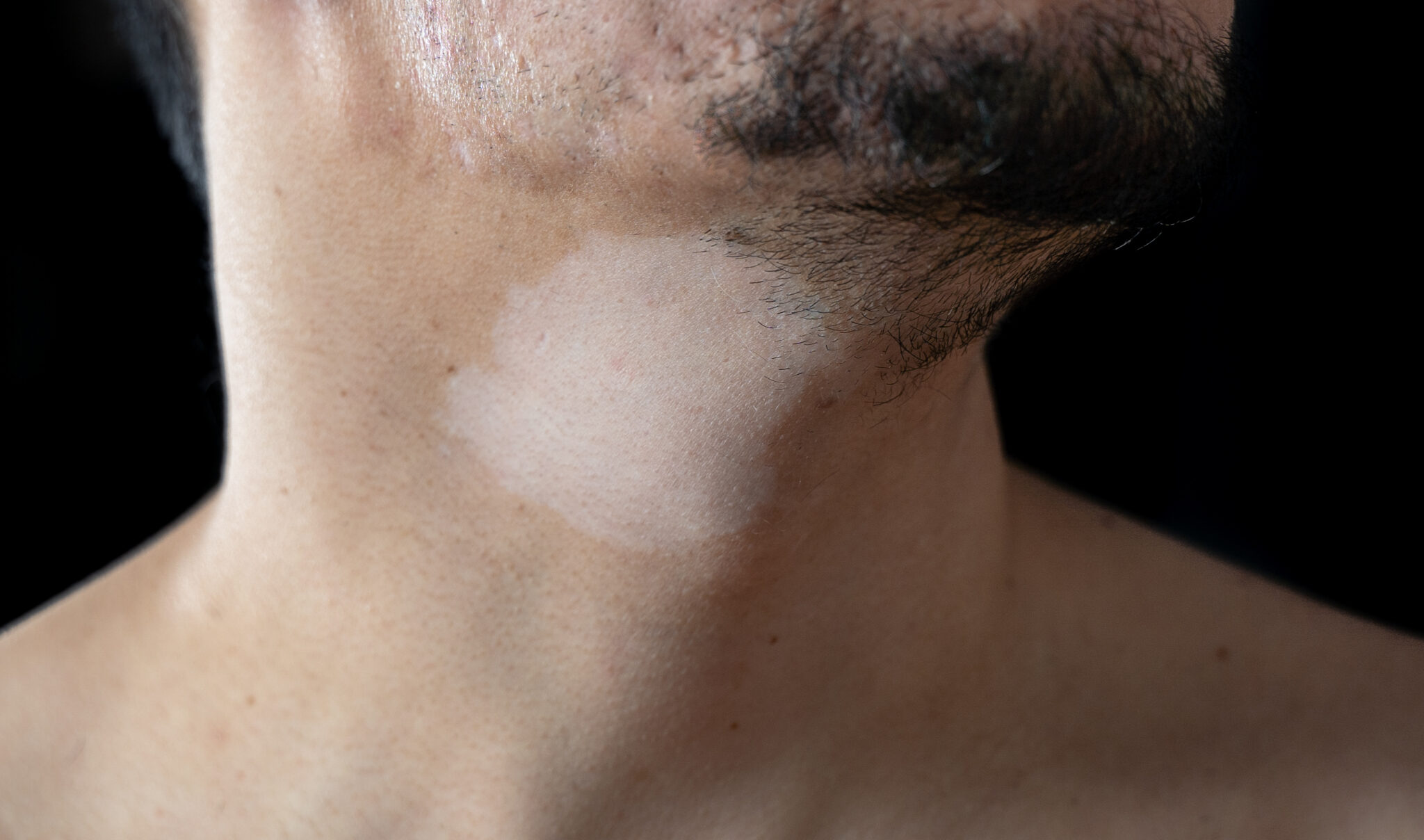 The Complete Guide on Pigmentation in Indian skin