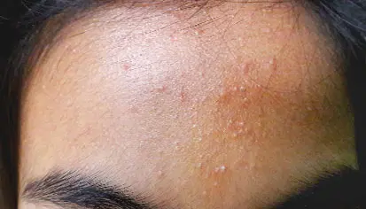 Fungal acne (pityrosporum folliculitis)