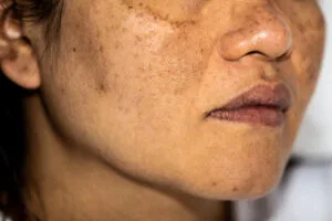 Melasma Causes: Best Treatment for Melasma on Face by Dermat