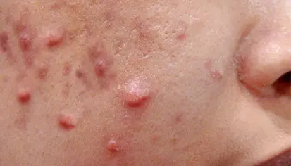 Nodular acne