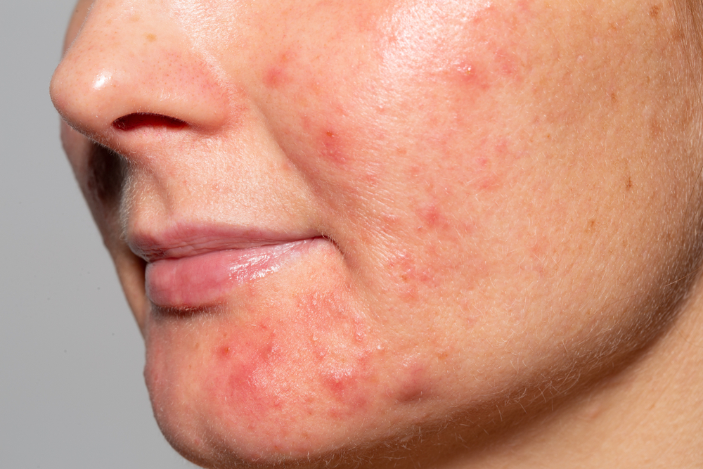 Symptoms and Causes Of Nodular Acne: How Is It Treated?