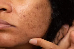 Causes and Treatment Of Post-Inflammatory Hyperpigmentation