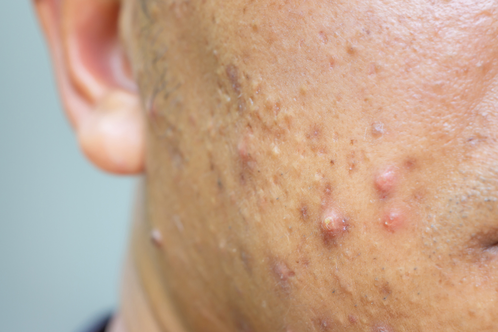 cystic acne-how it looks like