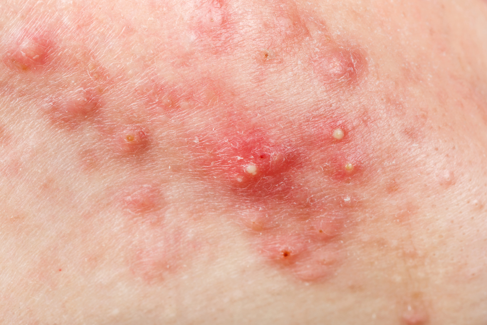 nodular acne-how it looks like