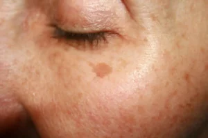 How do you get rid of sun spots on your face?