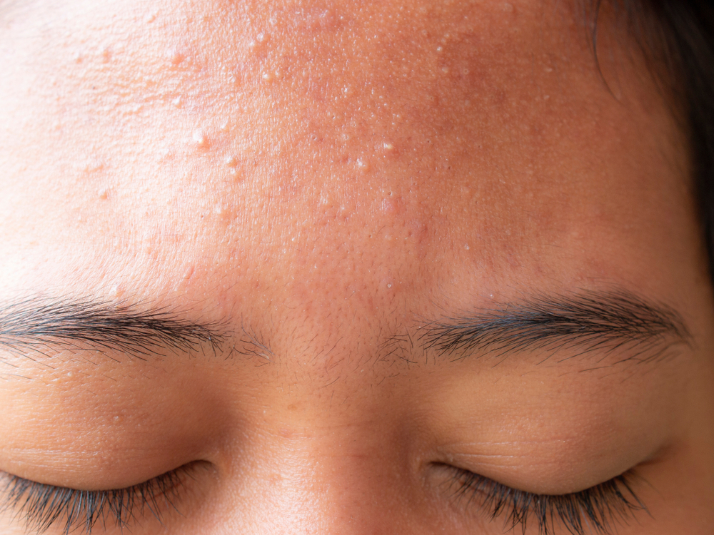 Forehead Acne Causes: Treatment Options by Dermatologists