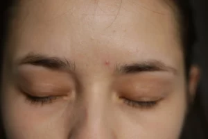 Acne between eyebrows: Causes, Treatment, and Prevention