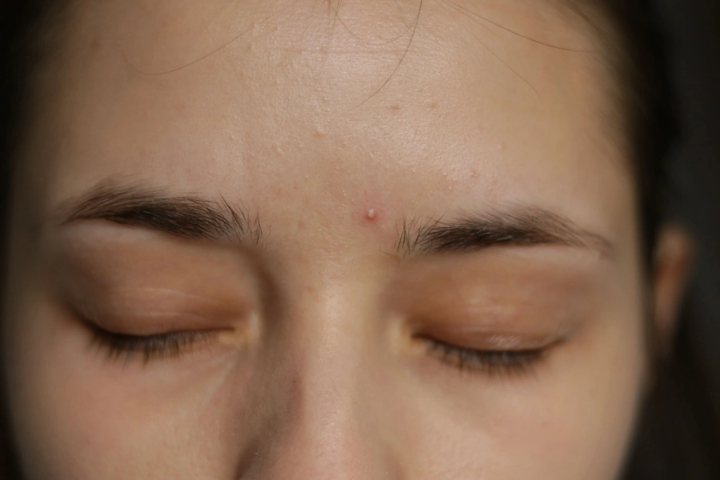 how to get rid of acne on forehead and between eyebrows