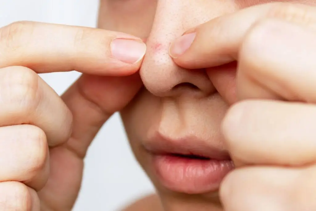 Relaxing With Great Acne On The Nose Acne on your nose? Causes, types, and treatment solutions | MFine