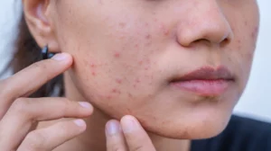 The Link Between Stress and Acne: How To Treat Stress Acne?